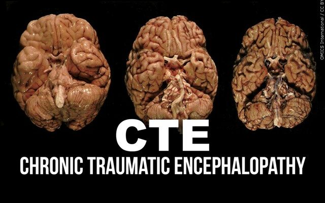 CTE Diagnosed In Major League Soccer Player For First Time